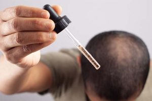 hombre aplicando minoxidil sobre el cuero cabelludo