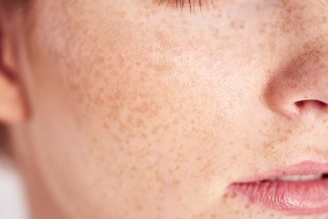 persona con fototipo de piel II