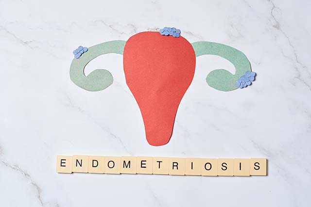 ilustración de endometriosis