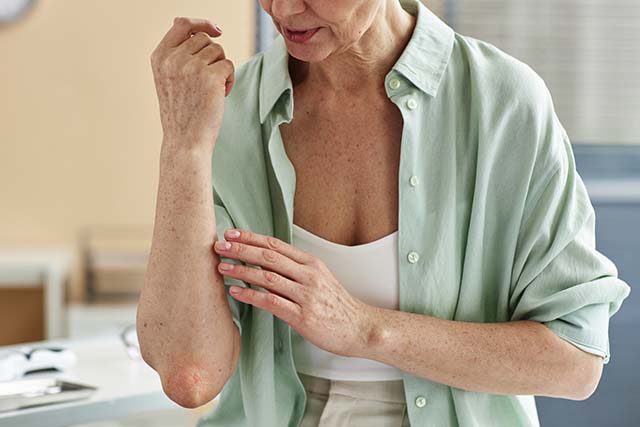 persona aplicando ácido kójico en su piel